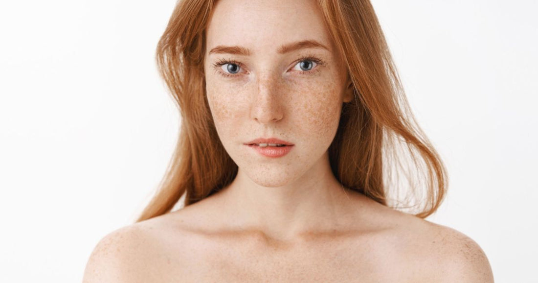 Close-up of skin with hyperpigmentation showing dark spots on cheeks