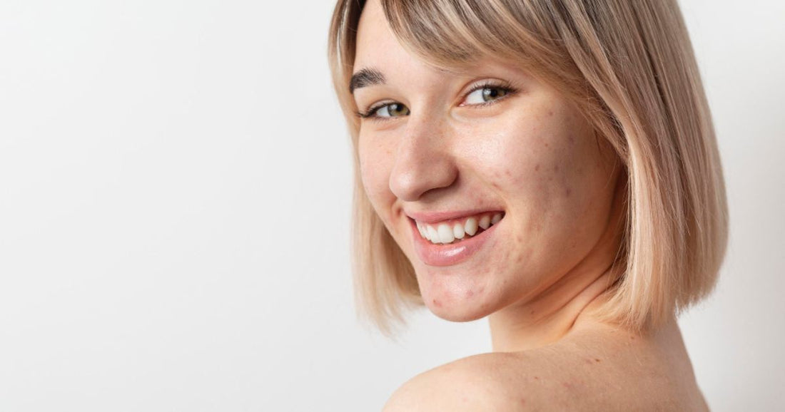 Skincare Routine for Oily & Acne-Prone Skin
