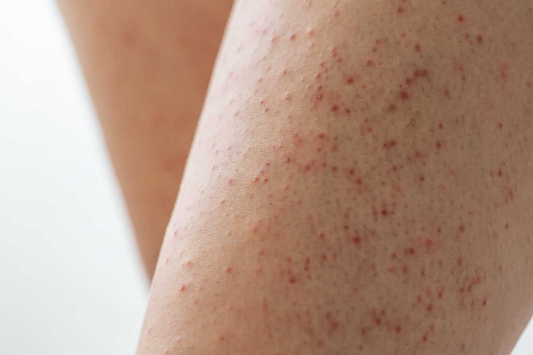 Common Misconceptions Behind Body Skin Imperfections