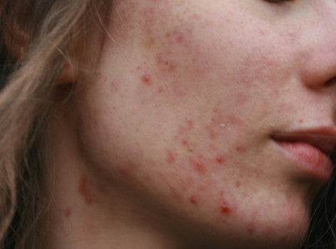 Congested Skin: What's Actually Happening Inside Your Pores
