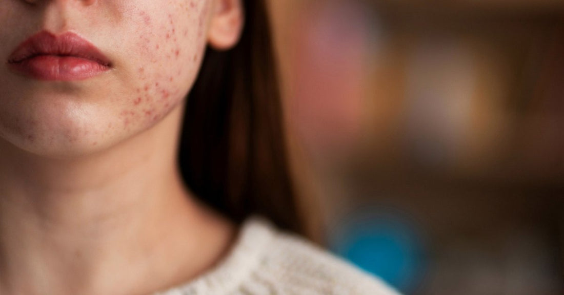 How to Reduce Redness on Your Face