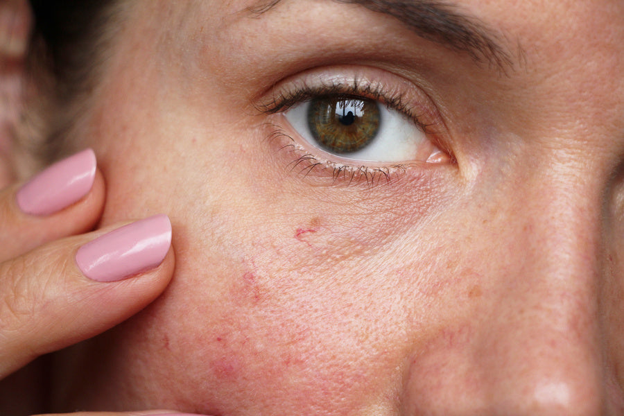 Why Skin Breaks Out at the End of Summer