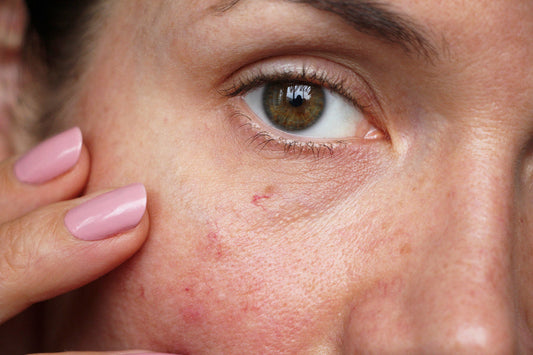 Why Skin Breaks Out at the End of Summer
