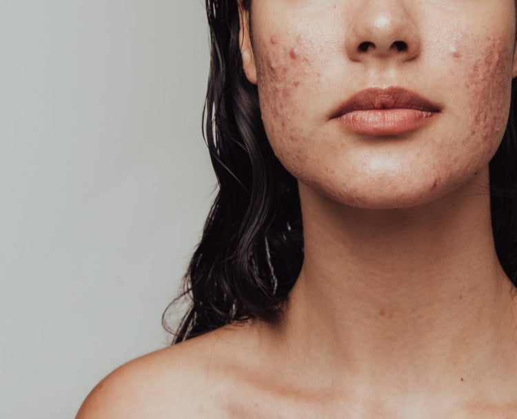 Blemished Skin with Severe Acne