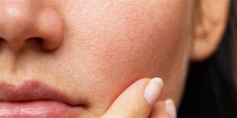 Dry Skin, Barrier is Compromised