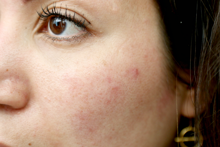 Sensitive Skin, Inflamed & with Redness