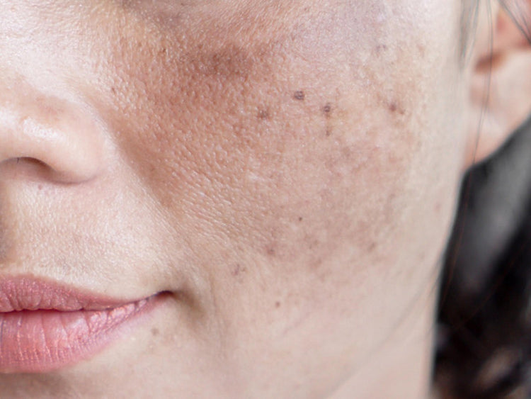 Superficial Melasma or Colored, Darker Spots